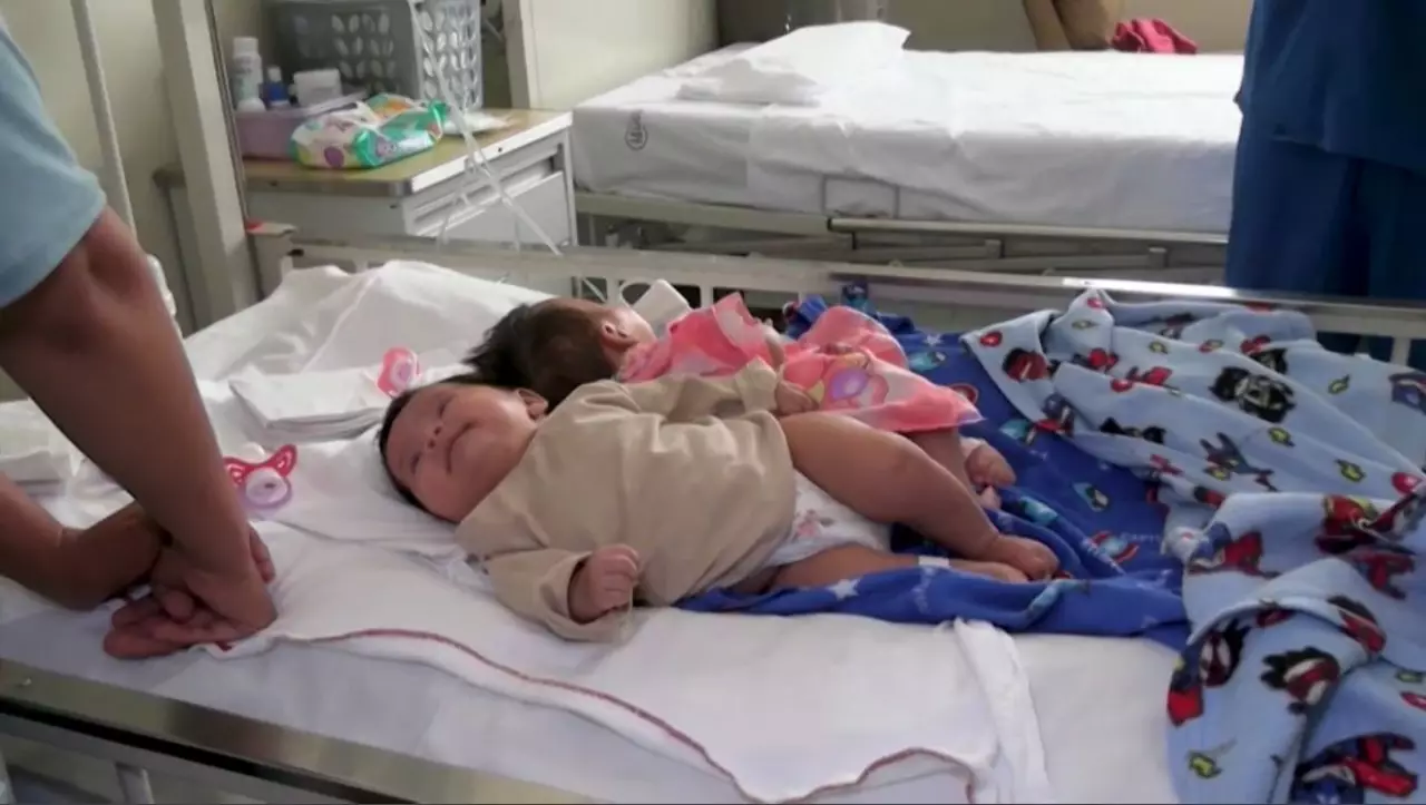 Перуде дәрігерлер сиам егіздерін ажыратты