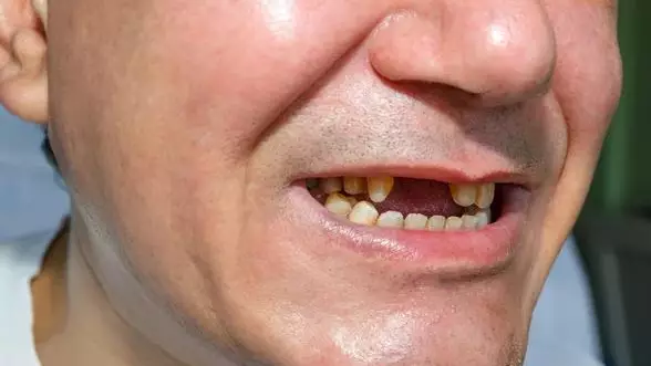 Тістің болмауы есте сақтау және ойлау қабілетіне кері әсер етеді – ғалымдар