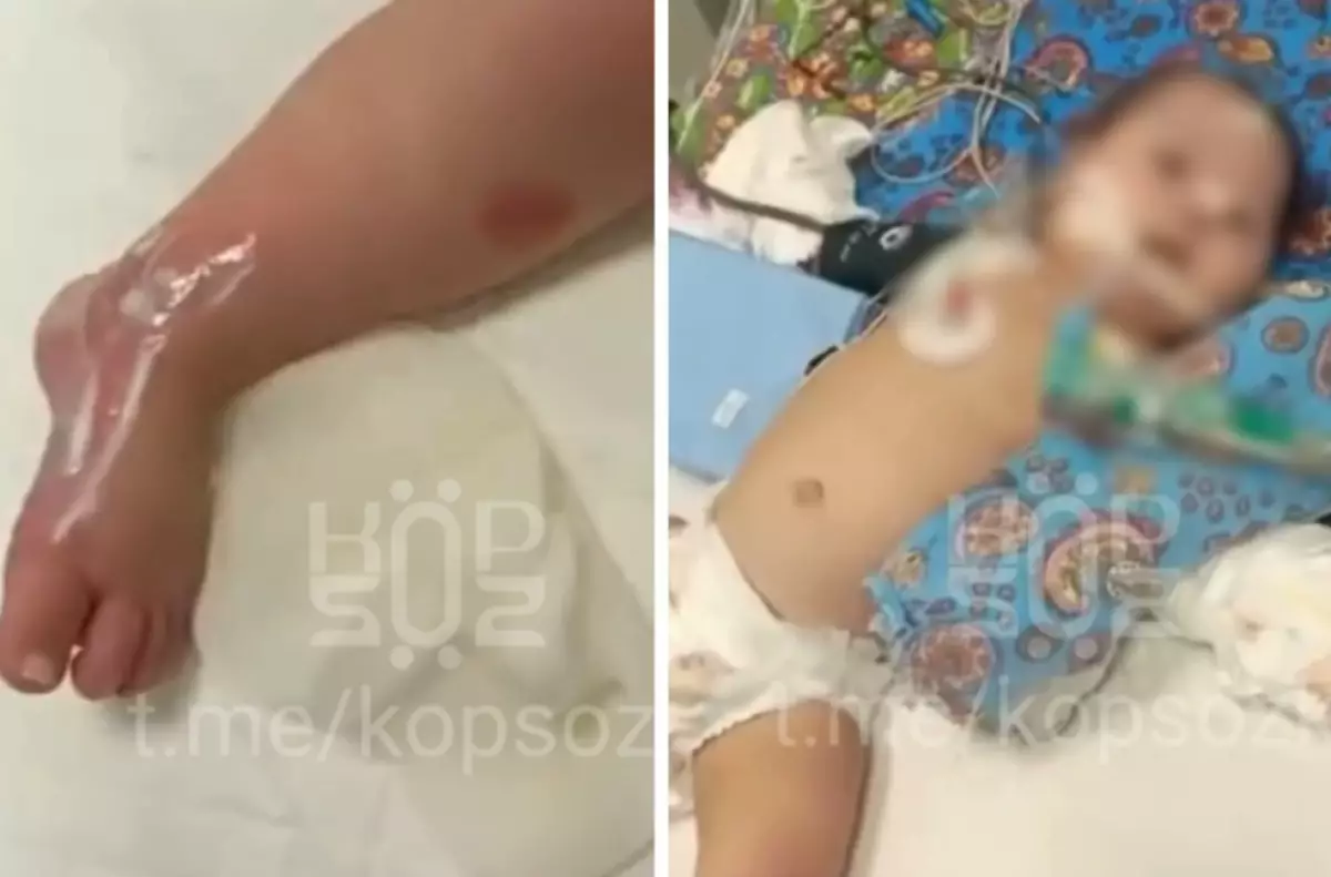 Астанада 9 айлық сәби ауруханада күйіп қалған