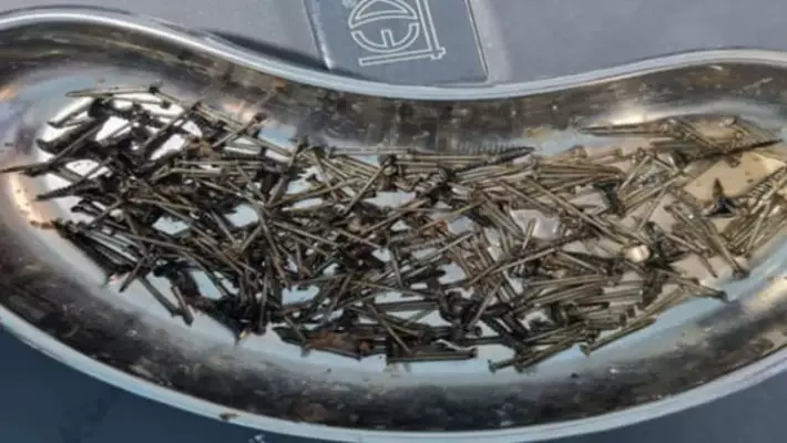 В Самарканде врачи извлекли из желудка мужчины 200 граммов гвоздей и саморезов