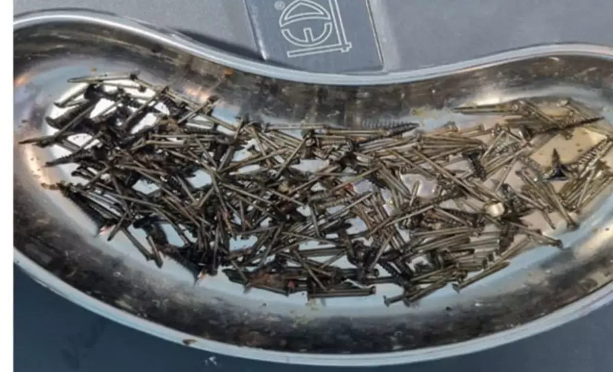 В Узбекистане мужчина из-за стресса проглотил десятки гвоздей и саморезов - новости на Lada.kz 07.01.2026