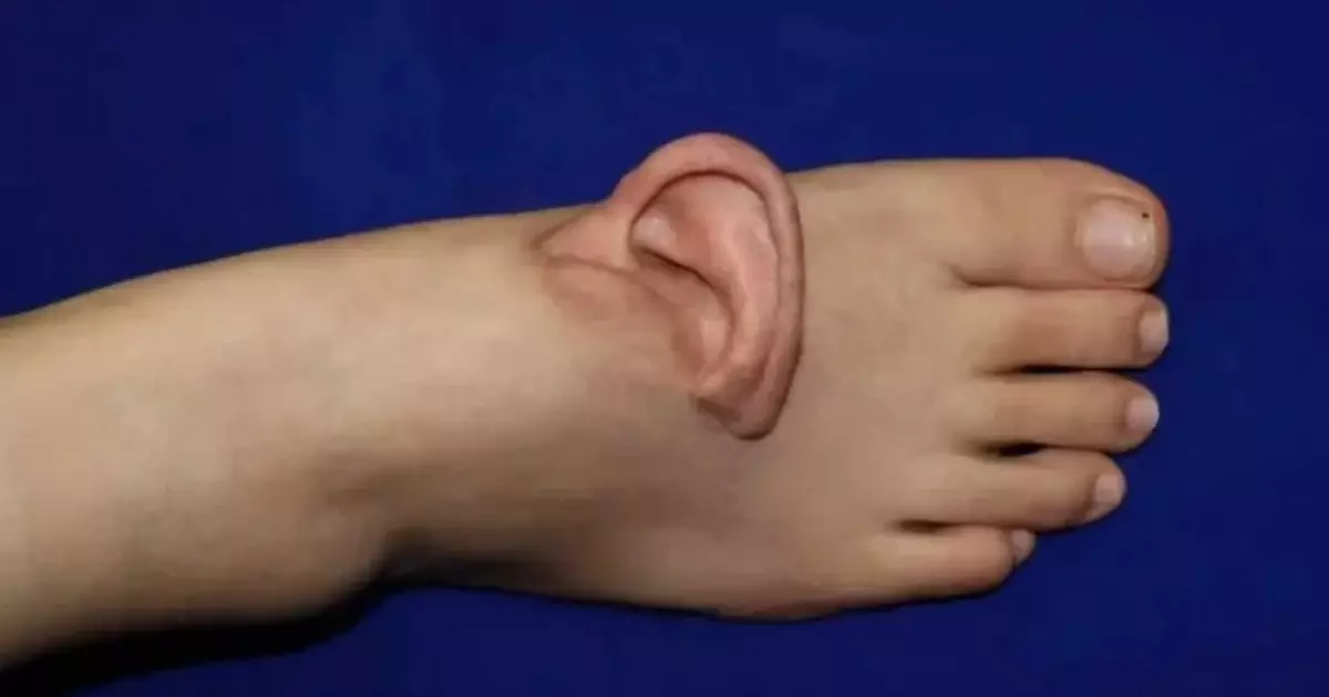  Қытайлық дәрігерлер науқастың құлағын оның аяғына тігіп, өмірін сақтап қалды 