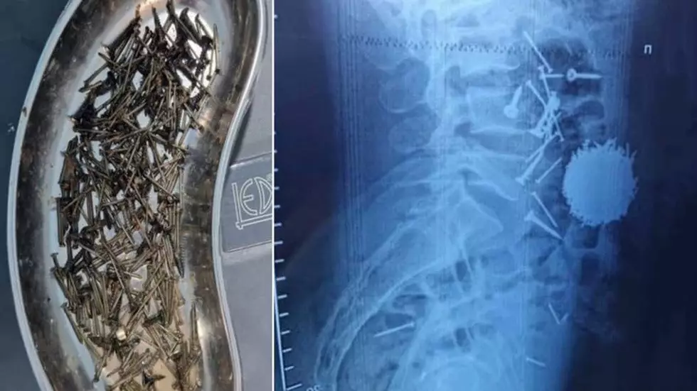 Өзбекстанда науқастың асқазанынан 200 грамм шеге шықты