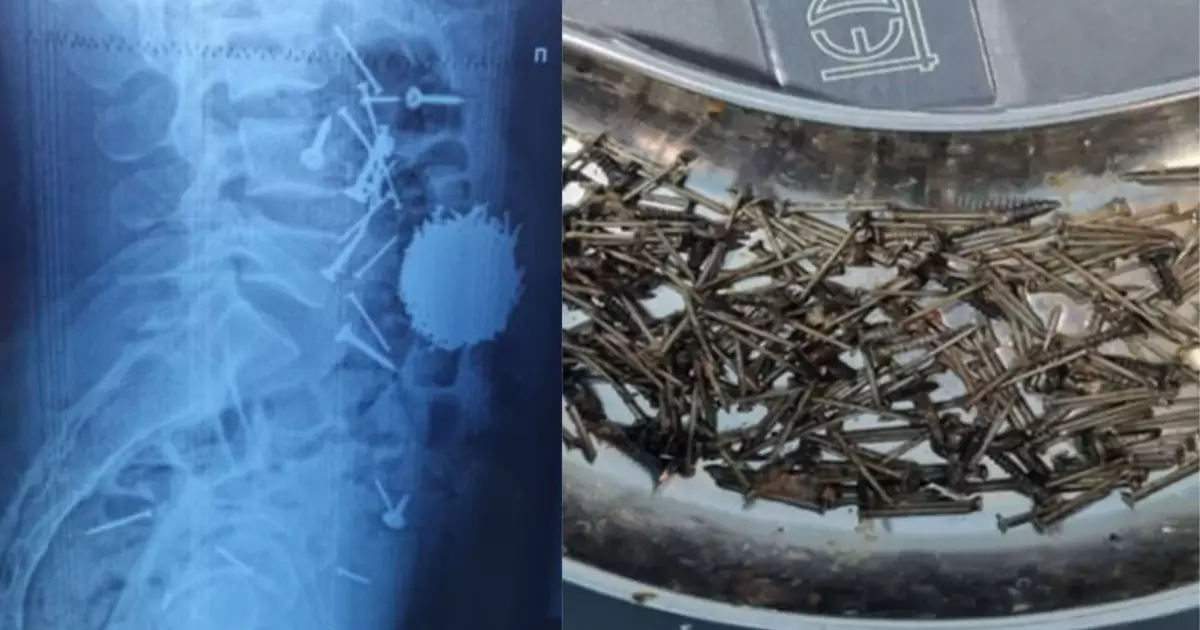  29 жастағы ер адам стресске түсіп кетіп, бірнеше шегені жұтып қойды (ФОТО) 