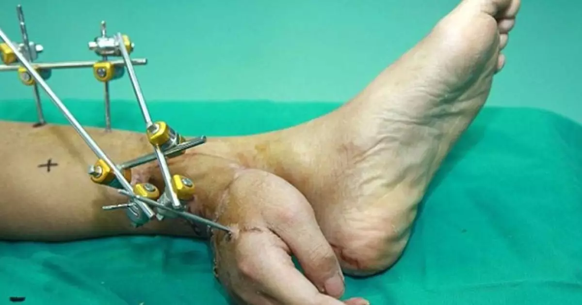  Қытайлық дәрігерлер науқастың жұлынып кеткен қолын оның аяғына тігіп, өмірін сақтап қалды 