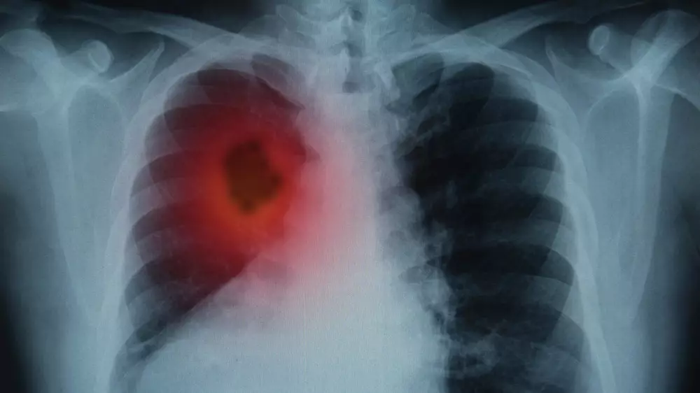 Врач назвал эффективный способ выявления рака легкого