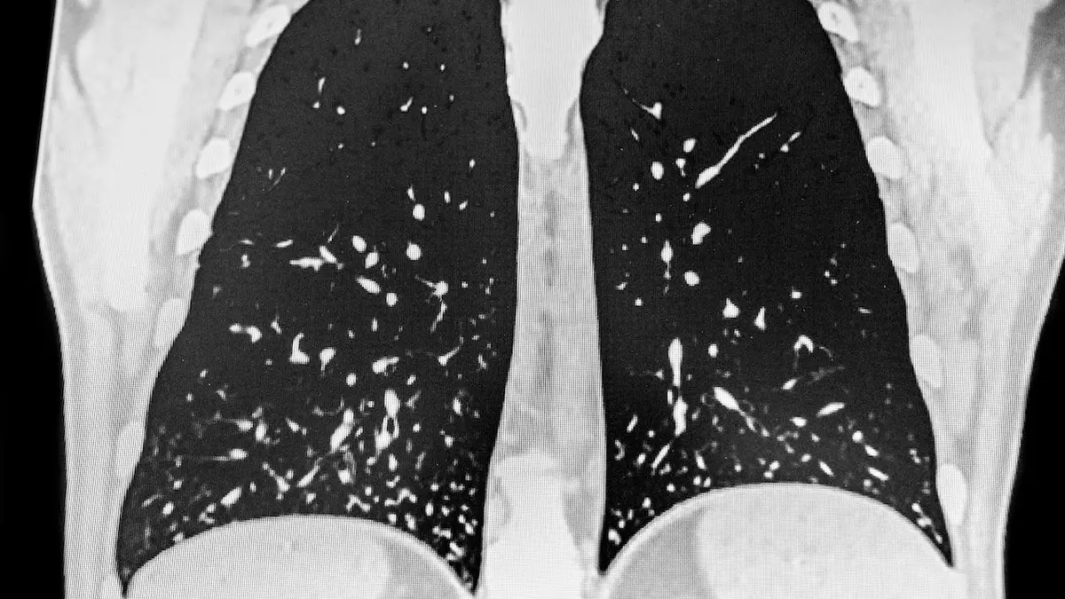 Десятки человек заболели из-за распространения потенциально смертельного грибка в южном штате.