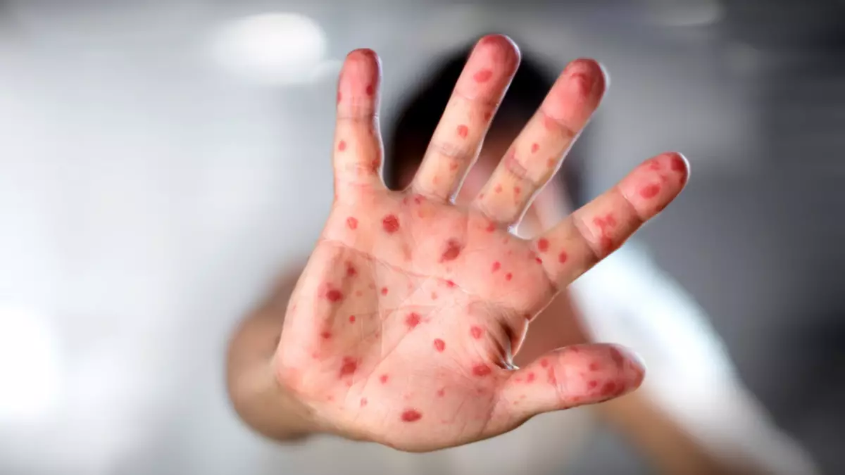 Астанада қызылша өршіп тұр: Дәрігерлер балалар үшін қауіп бар екенін ескертті