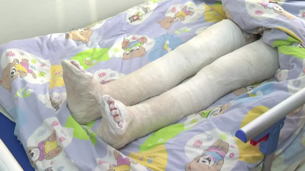 Таразда церебралды сал ауруына шалдыққан балаларға ота жасалады