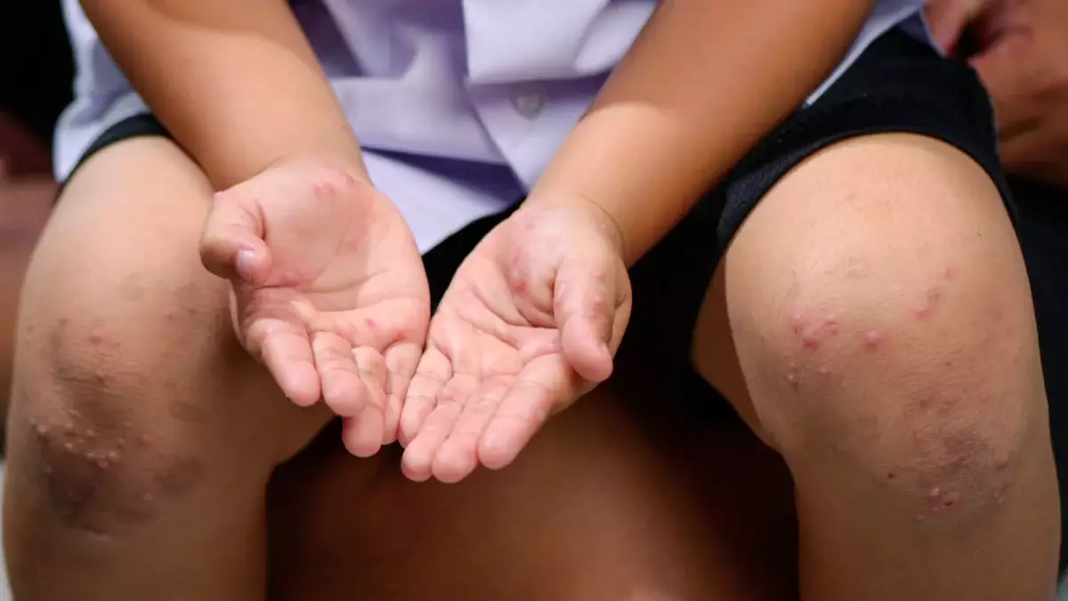 Дәрігерлер дабыл қақты: Астанада жыл басынан бері 380-нен астам адам қызылша жұқтырған