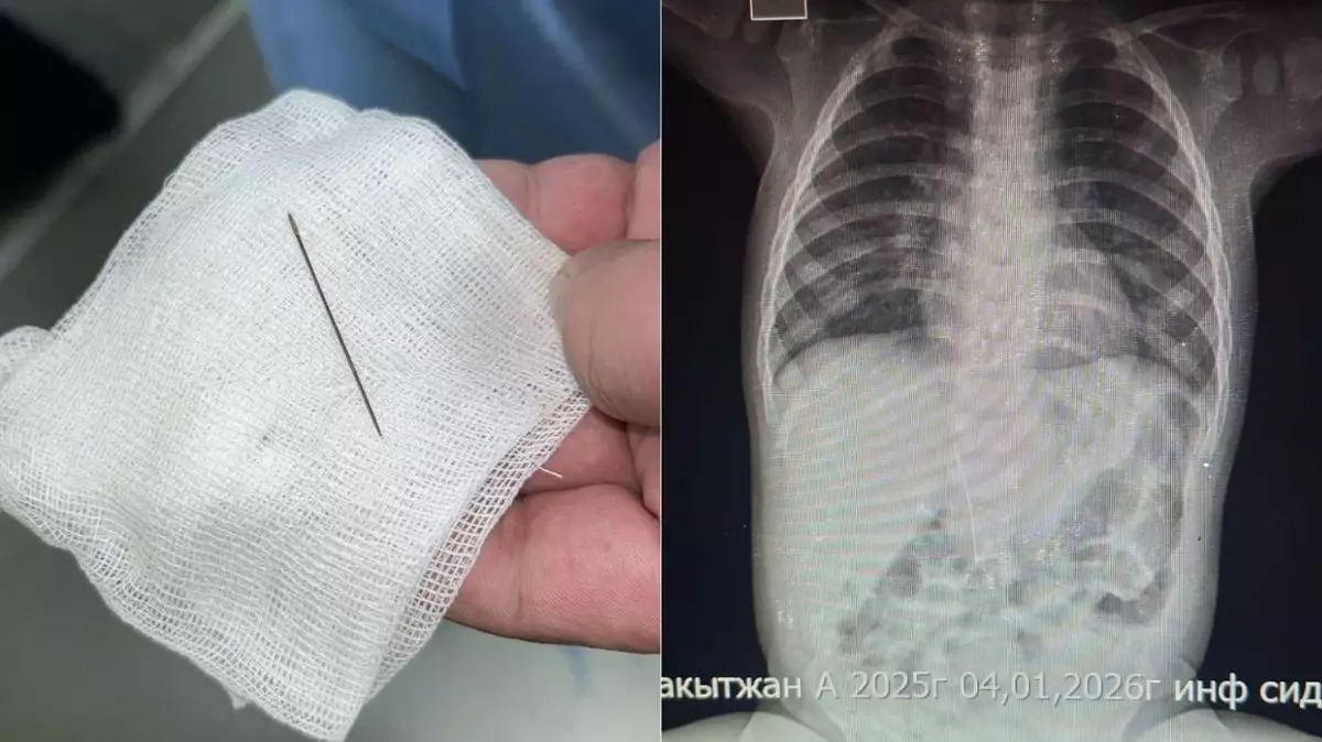 Сегіз айлық сәбидің іш қуысынан ине табылды