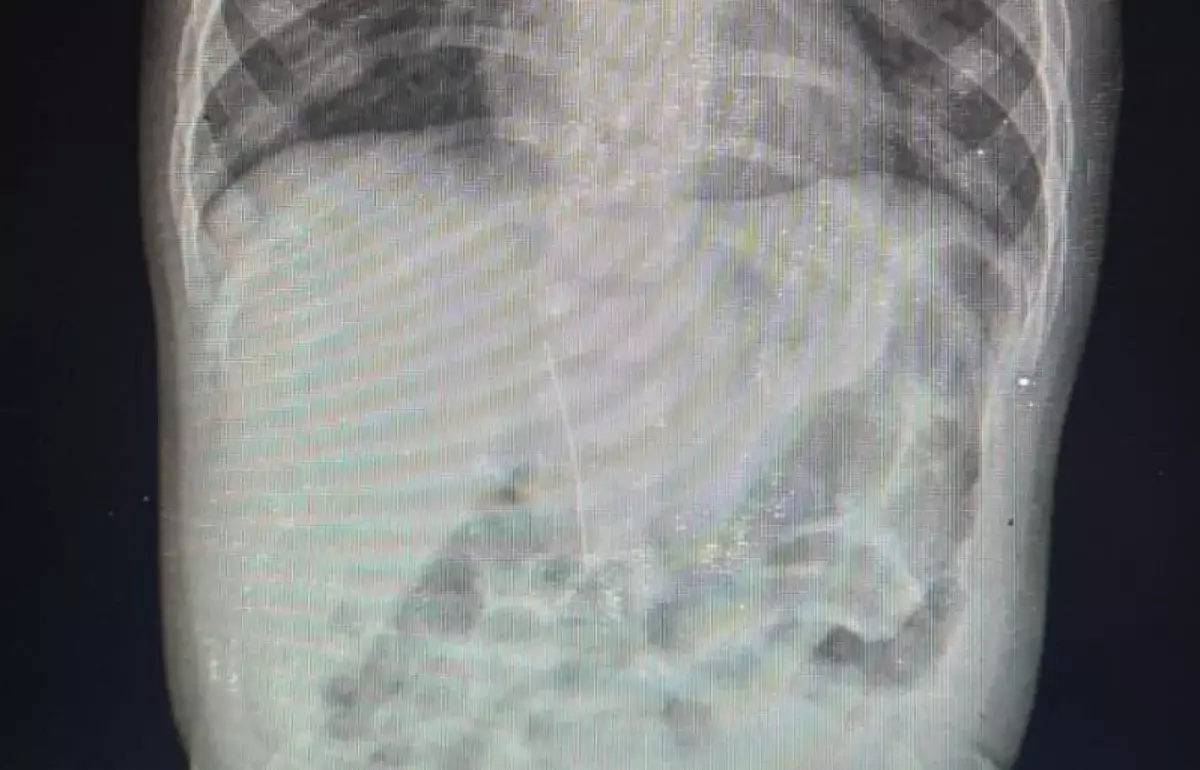 Иглу нашли в брюшной полости младенца в Туркестане