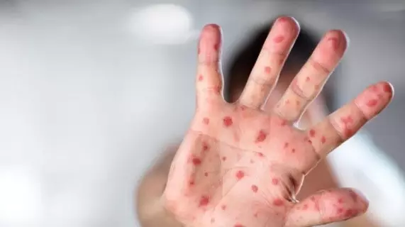 Карантин из-за вспышки кори объявлен в военном колледже Акмолинской области