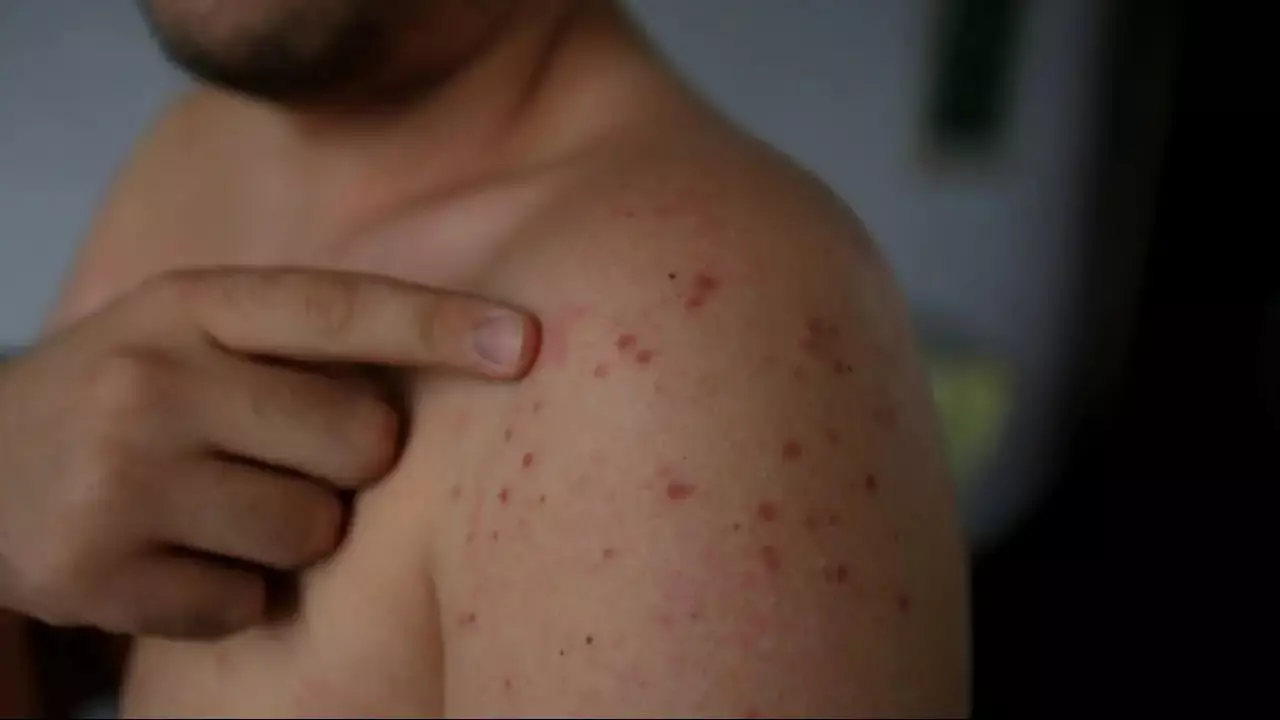 Щучинск колледжінде жаппай ауру: 66 кадеттен қызылша анықталды