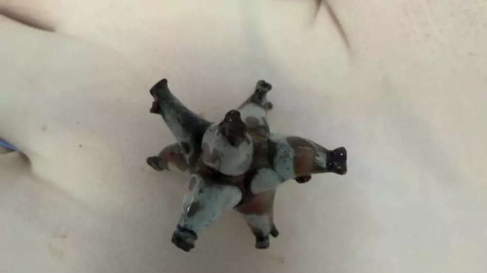 Шымкентские врачи удалили из почки пациента крупный камень необычной формы