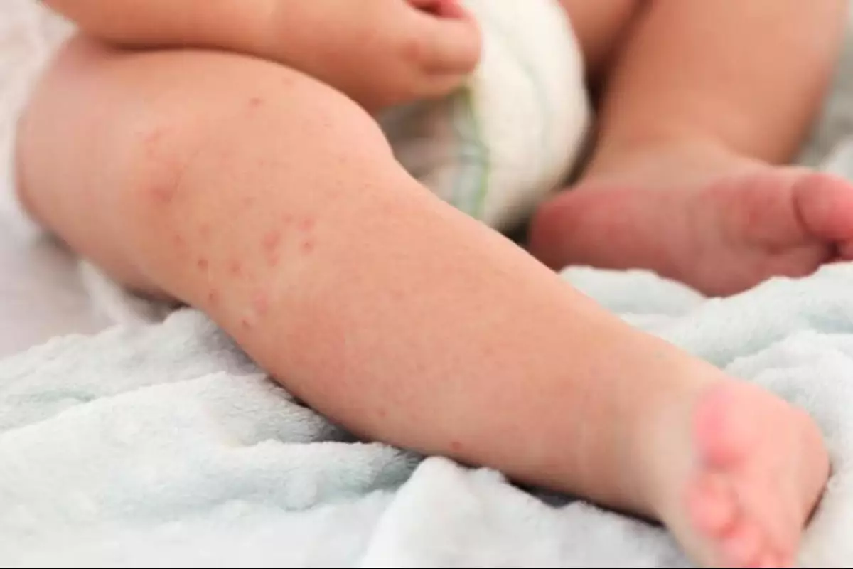 До 20 новых случаев кори в неделю фиксируют в Атырауской области