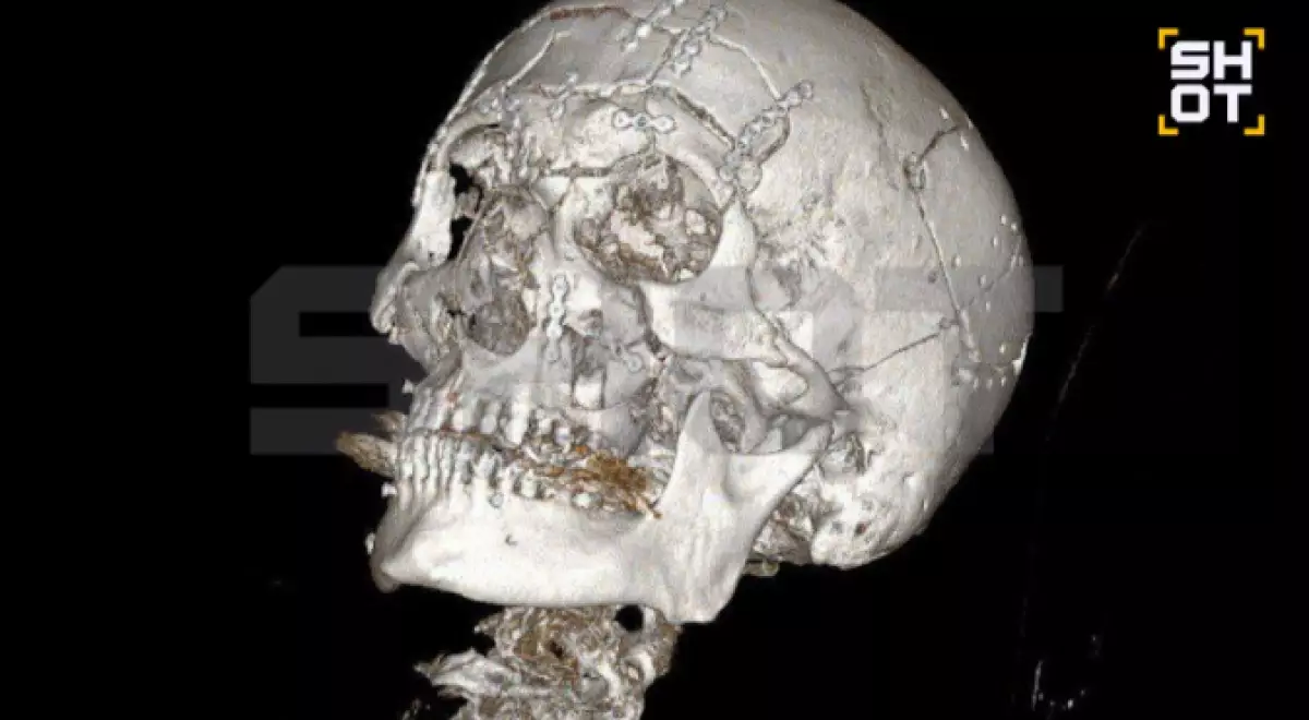 Собрали как пазл: мужчине раздробило лицо после падения со снегохода