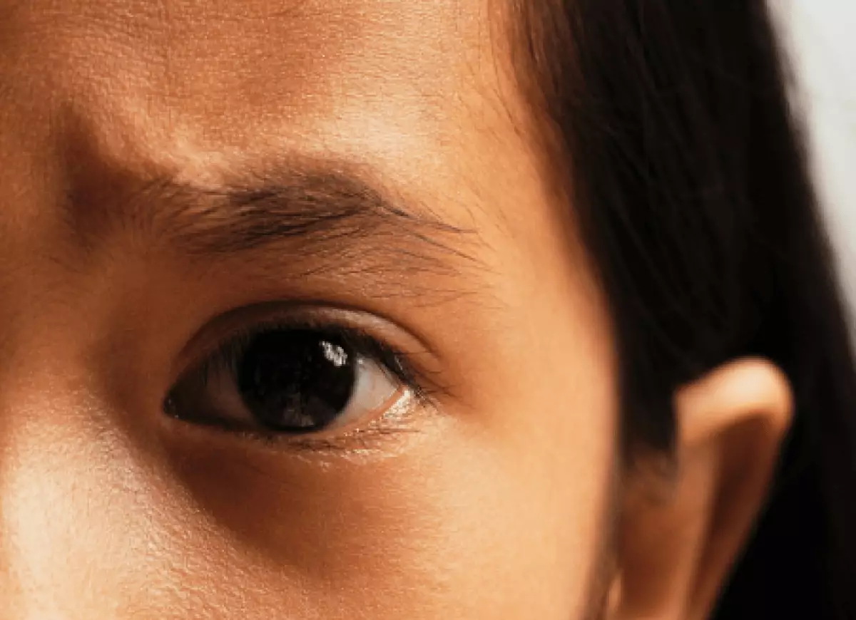 Прыщ на лбу довел россиянку до больницы