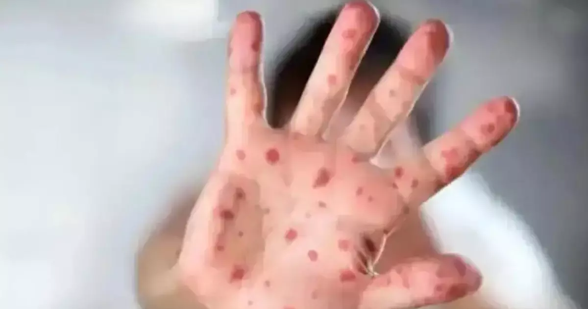  Ақтөбеде балалар арасында қызылша жұқтырғандар көбейді 