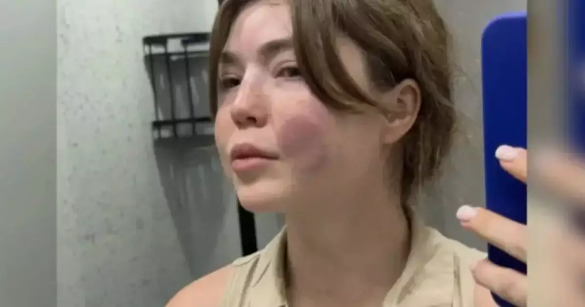  Алматыда соққыға жығылған әйел күйеуімен ажыраса алмай отыр 