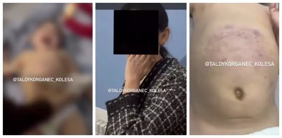 Талдықорғанда әкесі аяусыз ұрған баланың жағдайы белгілі болды