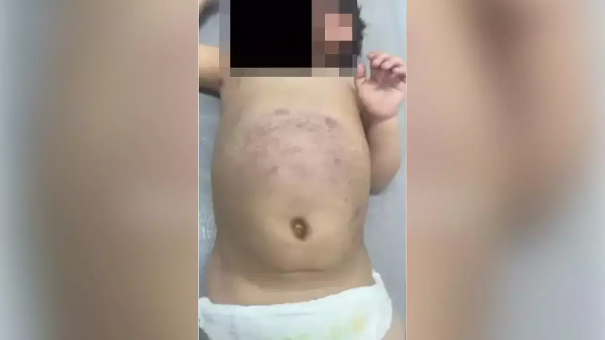 Жетісуда әкесі аяусыз ұрған үш жасар бүлдіршін хирургиялық бөлімде жатыр