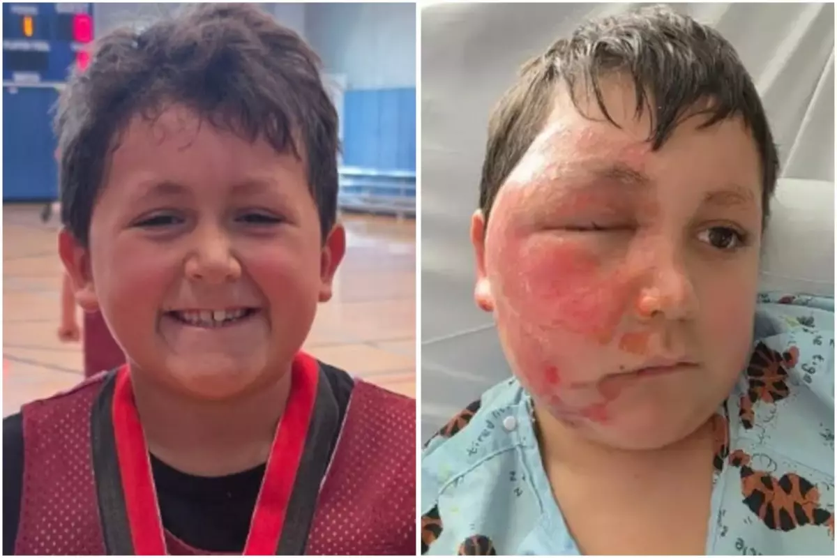 Ребенок получил ожоги лица из-за тренда в Tik-Tok (ВИДЕО)