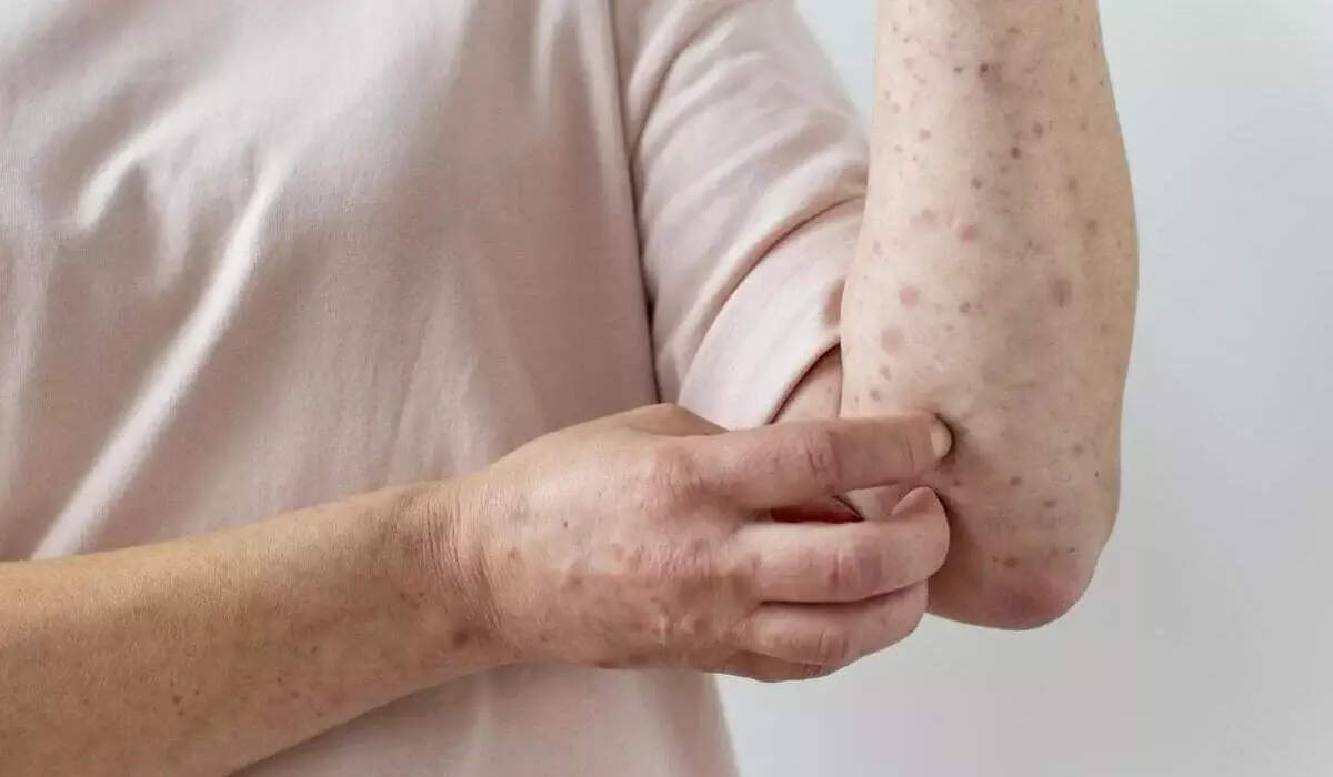 Около 2 тысяч заболевших с начала года: в Казахстане растет заболеваемость корью