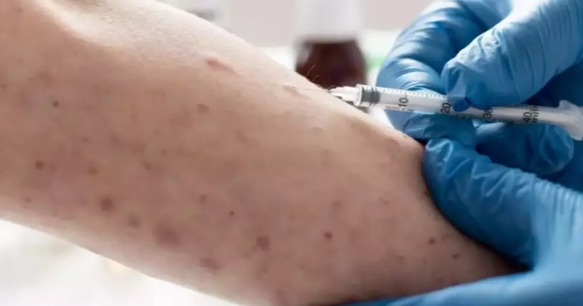  Екі мыңға жуық адам: Денсаулық сақтау министрлігі қызылшаға байланысты дабыл қақты 