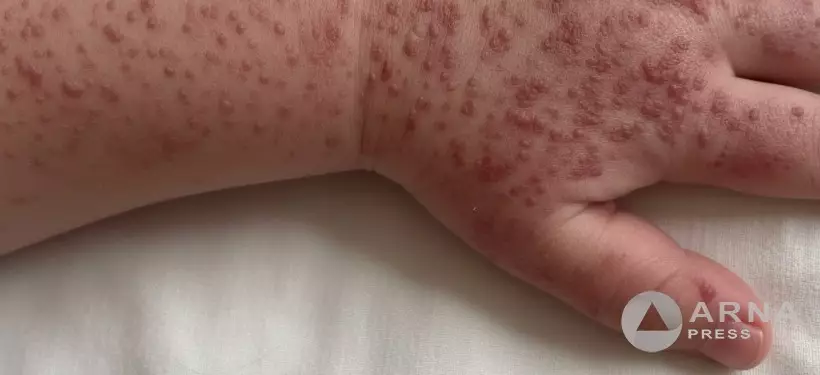 КСЭК обратился к казахстанцам из-за роста заболеваемости корью