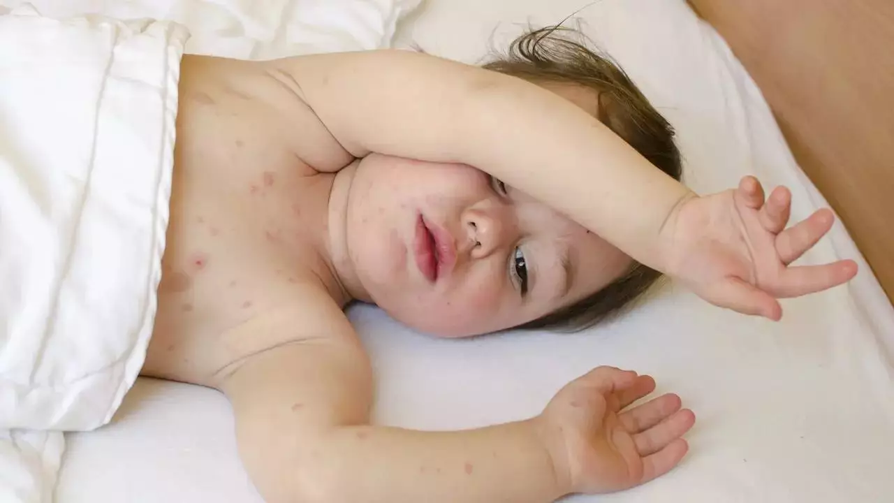 Қазақстанда қызылша өршіді: Ауырғандардың басым бөлігі – екпе алмаған балалар