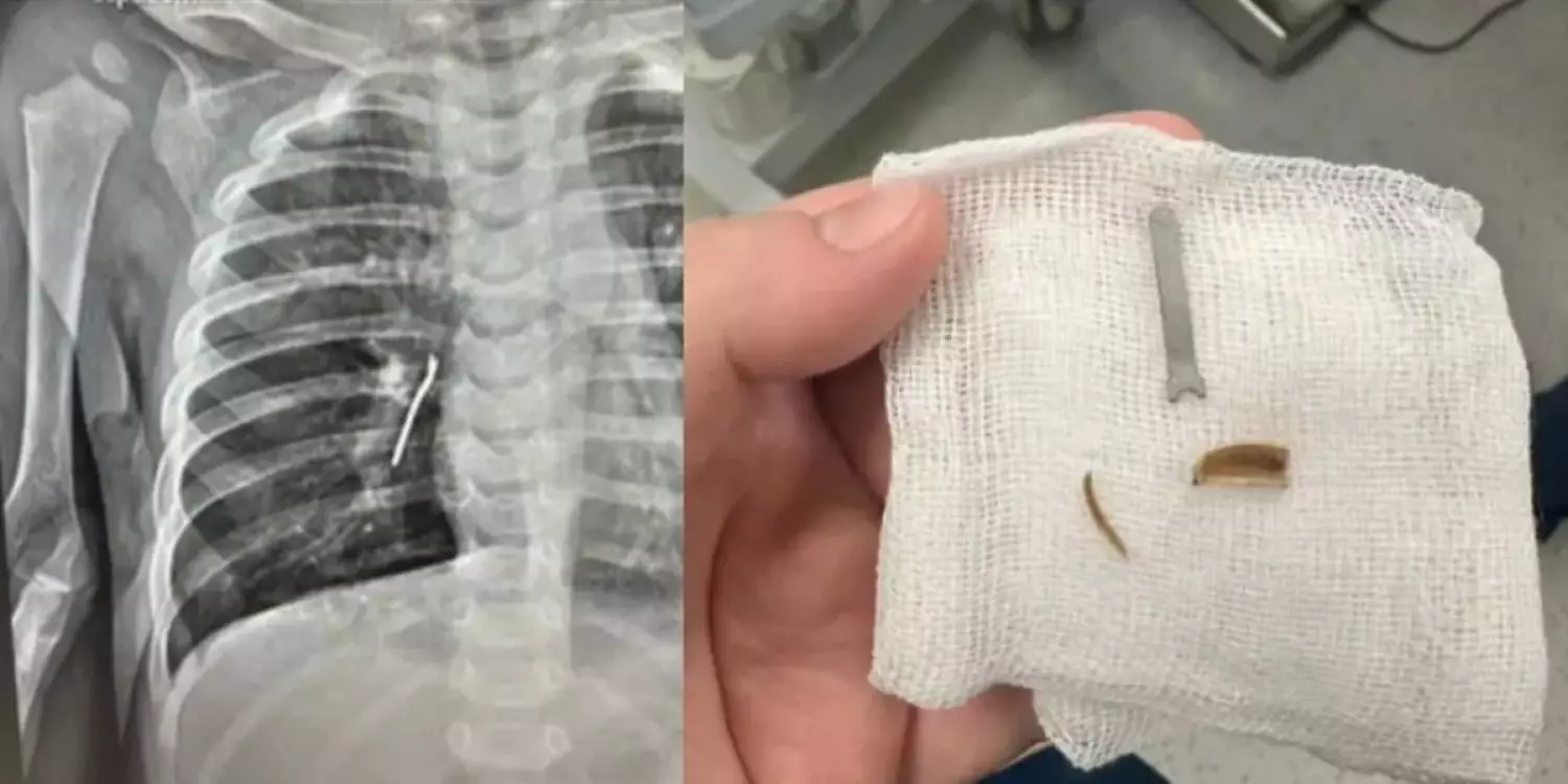 Ақтауда 11 айлық баланың өкпесінен темір бөлшегі мен тұқым қабығы табылды