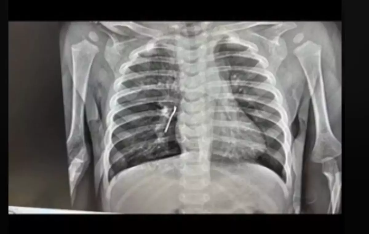 Ақтауда 11 айлық баланың өкпесінен шемішкенің қабығы табылды