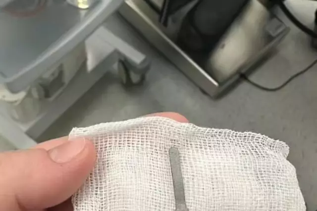 Ақтауда дәрігерлер сәбидің өкпесінен темір зат алып шықты