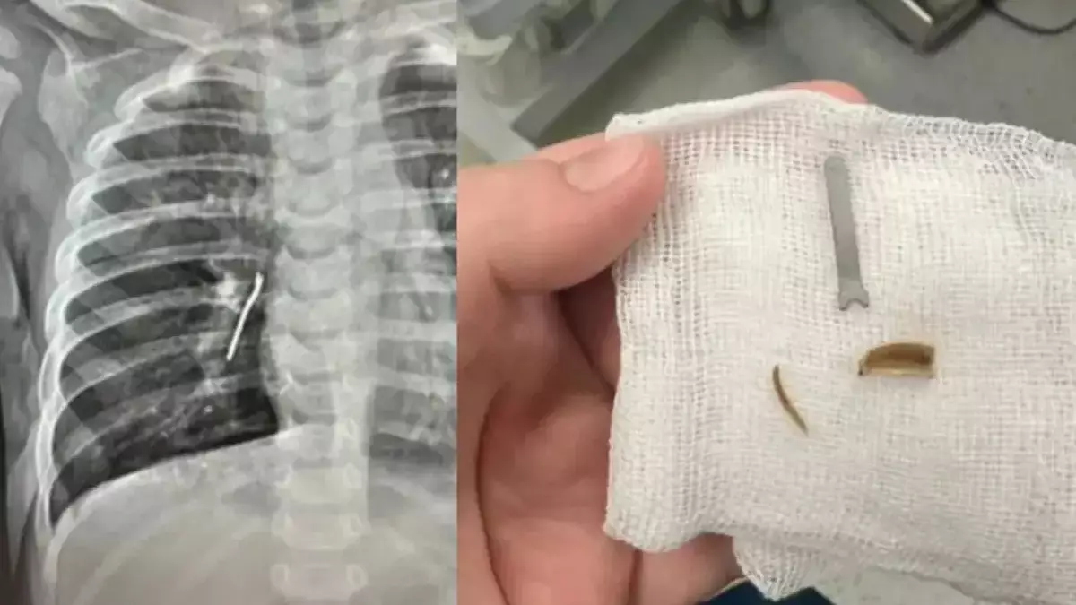 Ақтауда 11 айлық сәбидің өкпесінен шемішкенің қабығы мен темір табылды