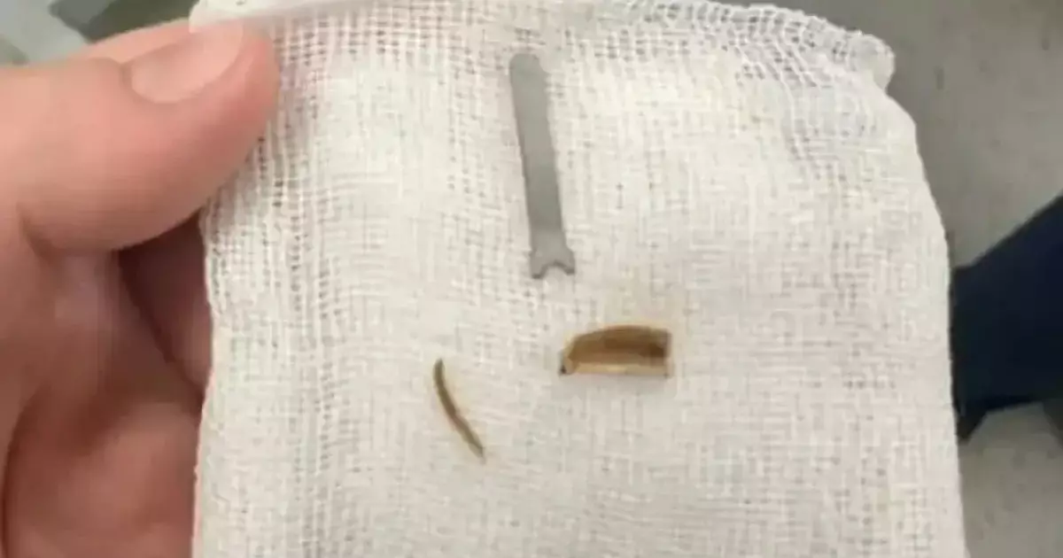  Ақтауда 11 айлық сәбидің өкпесінен металл табылды 