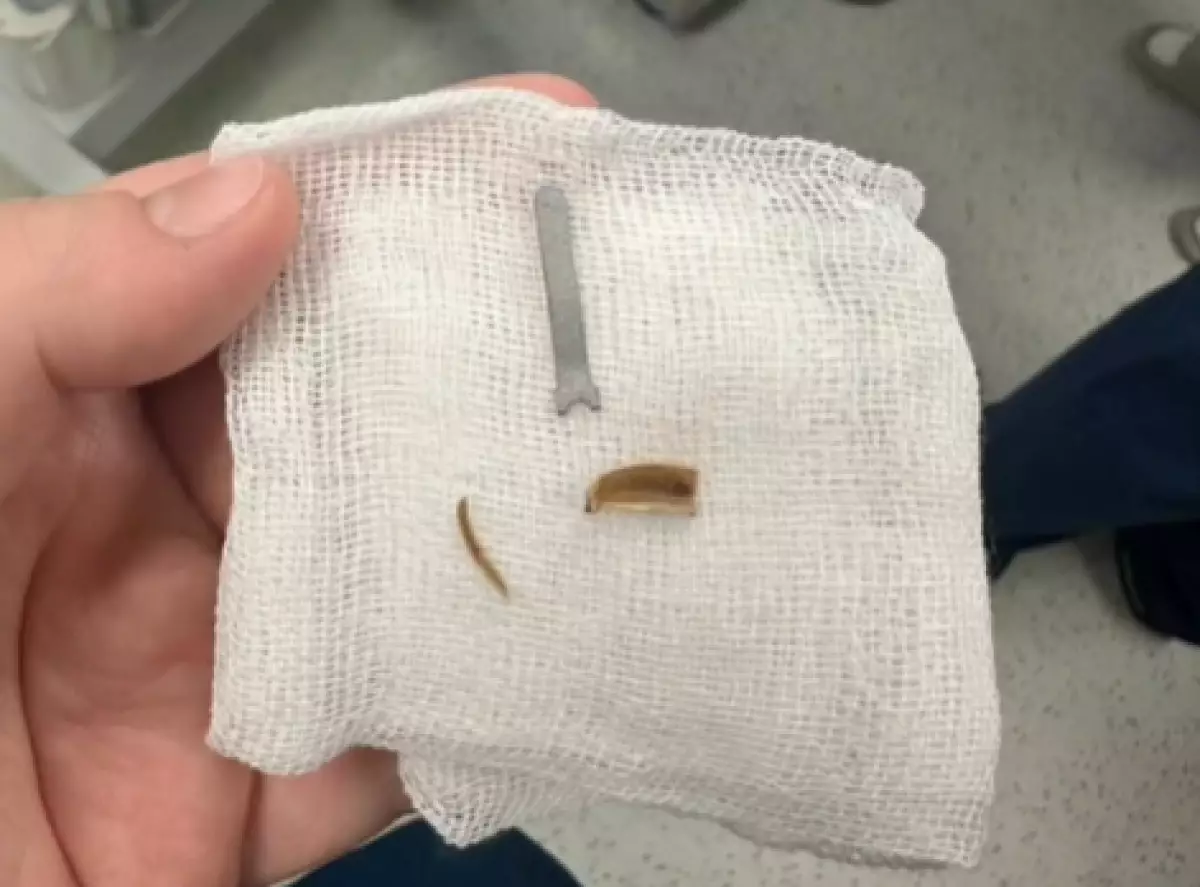 Железка месяцами скрывалась в легких ребенка из Мангистау