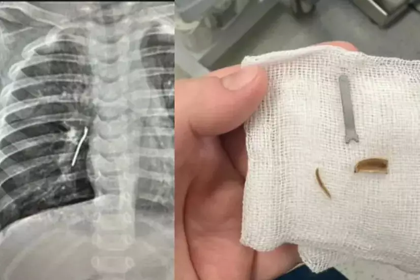 В Актау из лёгких годовалого ребёнка извлекли кожуру семечки и металлический предмет