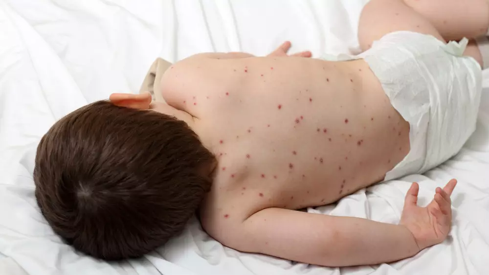 “Идеальный шторм“ в здравоохранении: почему корь снова вернулась