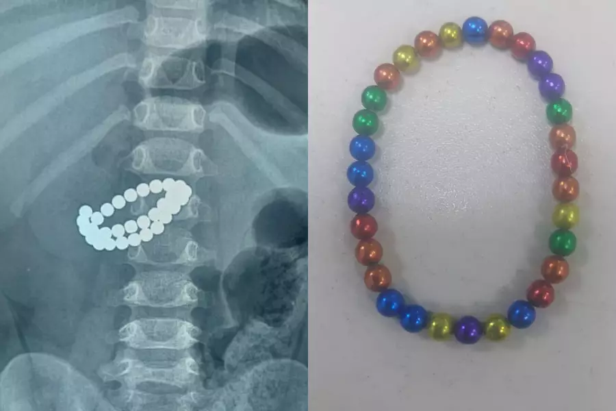 Алматыда бала 31 магнит жұтып қойған