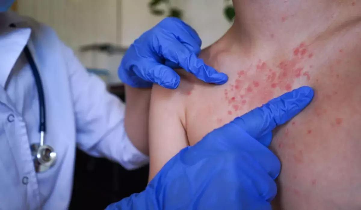 Заболеваемость корью среди детей почти вдвое выросла в Мангистауской области