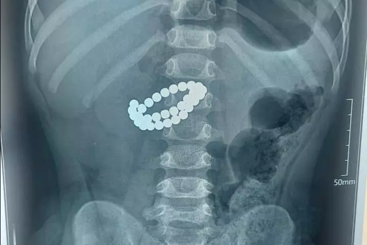 В Алматы спасли ребёнка, проглотившего 31 магнит