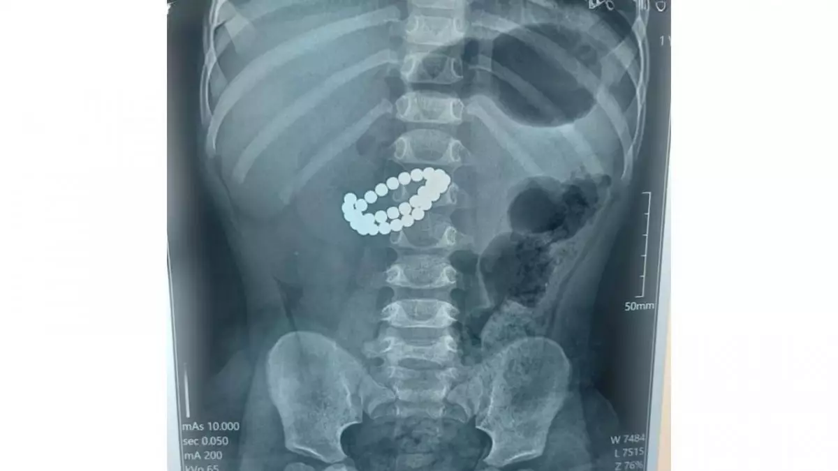 Алматыда 31 магнит жұтып қойған бір жасар балаға шұғыл ота жасалды