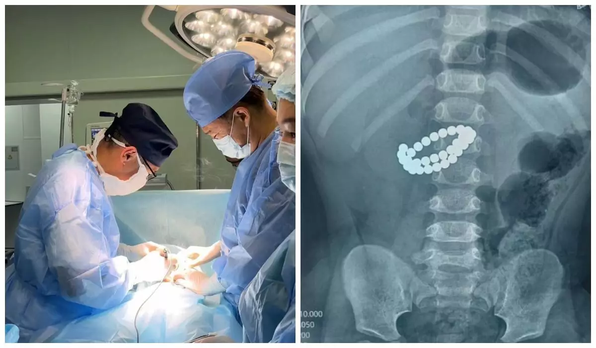 Алматыда дәрігерлер 1 жасар баланың ішінен 31 магнит алып шықты