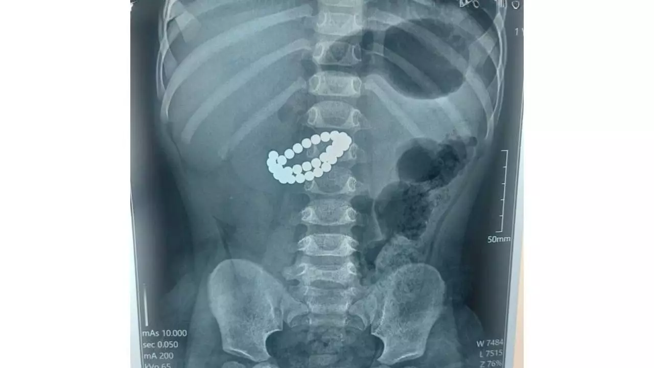 Алматыда 1 жасар сәби 31 магнит жұтқан: «Ішек қабырғасын теседі»