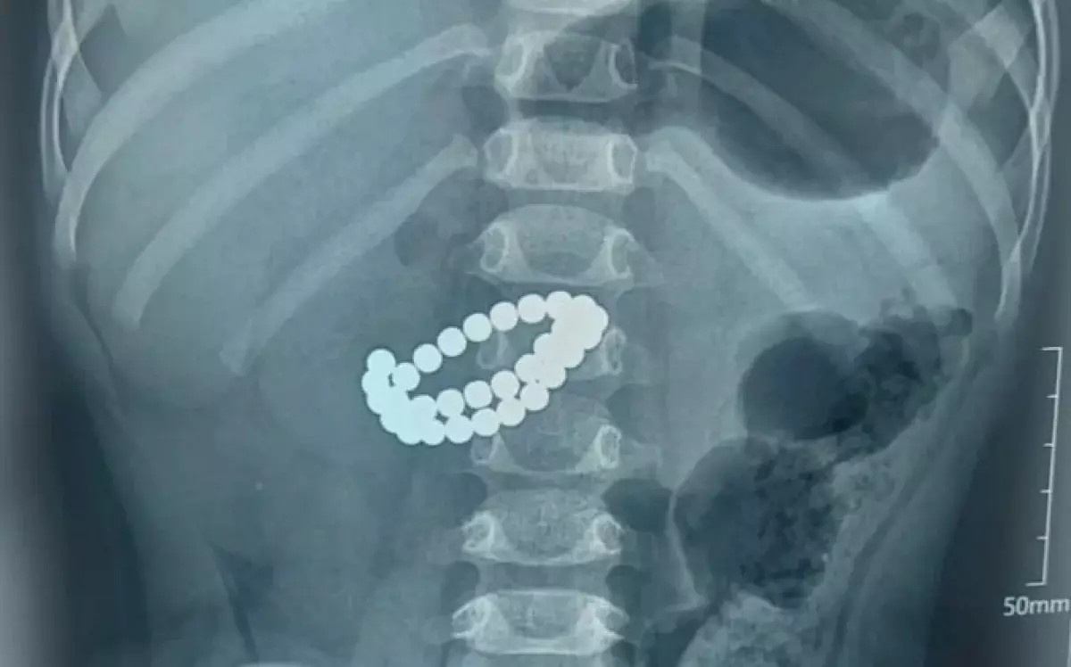 Алматыда екі жасар бала 31 магнит жұтып қойған