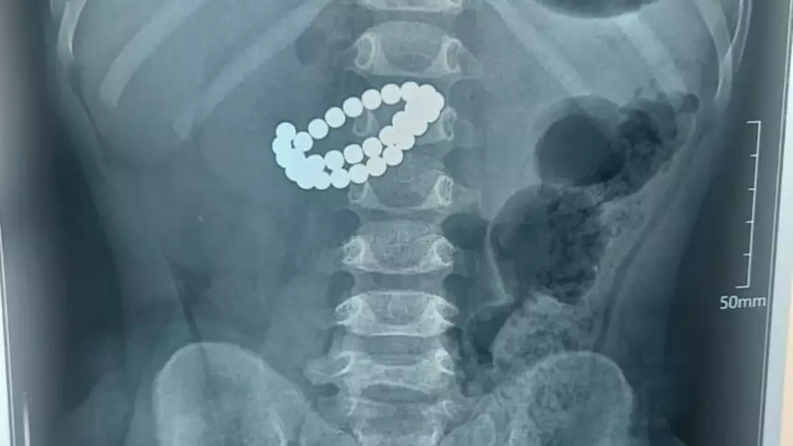 Алматыда бір жасар бала 31 магнит жұтып қойған