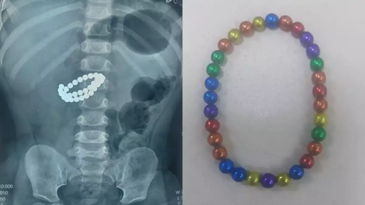 Алматыда сәби 31 магнит жұтып қойған. Оның жағдайы қалай?