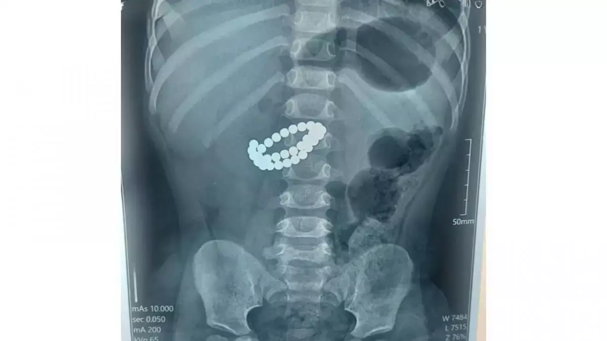 Алматыда дәрігерлер 31 магнит жұтып қойған сәбидің өмірін сақтап қалды