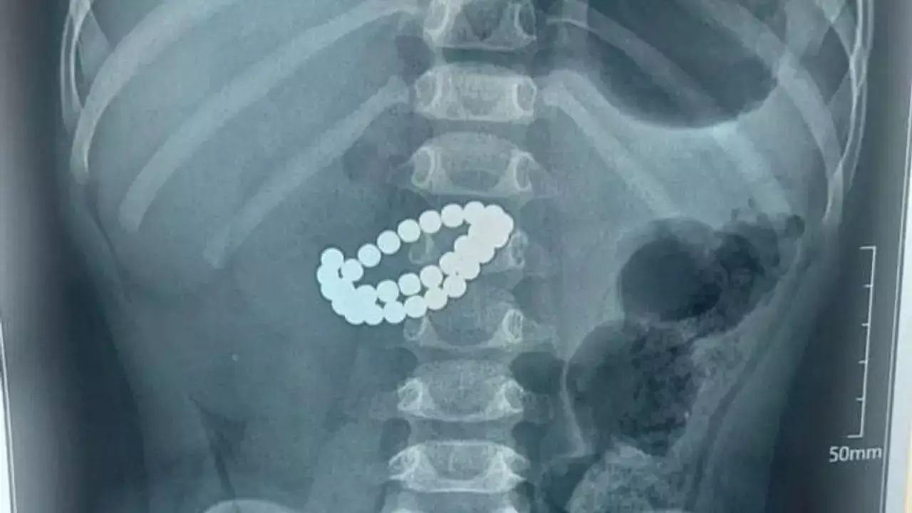 В Казахстане ребенка, проглотившего 31 магнит, спасли хирургическим путем.